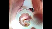 Electrosounding cervix