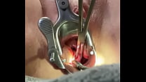 Sosteniendo el cuello uterino con el tenáculo mientras el dilatador mm folla el útero