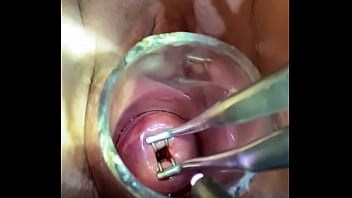 O dilatador de cozimento entra através do espéculo endocervical