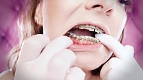 ASMR: upgraded braces with chain-link rubber bands and nitrile gloves (Arya Grander)
